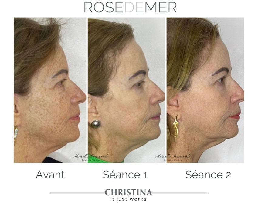 Peeling du visage à Reims